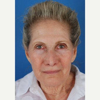 77 year old woman treated with facelift Revision and endoscopic brow lift before 3577879
