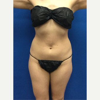 25-34 year old woman treated with Laser Liposuction before 3142285