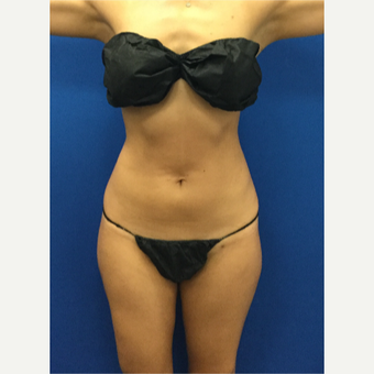 25-34 year old woman treated with Laser Liposuction after 3142285