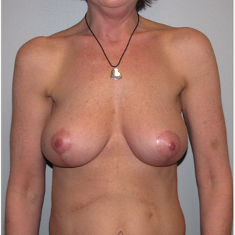 45-54 year old woman treated with Breast Reduction after 3663508