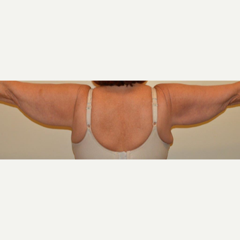 55-64 year old woman treated with Arm Lift before 3659466