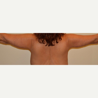 55-64 year old woman treated with Arm Lift after 3659466