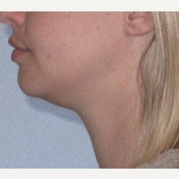25-34 year old woman treated with Liposuction before 3507764