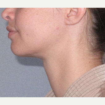 25-34 year old woman treated with Liposuction after 3507764