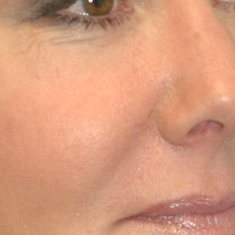 50 year old woman treated with Voluma to the midface after 3543436