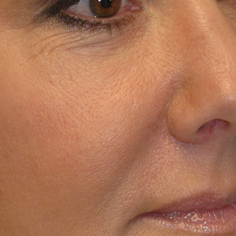 50 year old woman treated with Voluma to the midface before 3543436