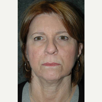 63 year old woman treated with Facelift before 3710750