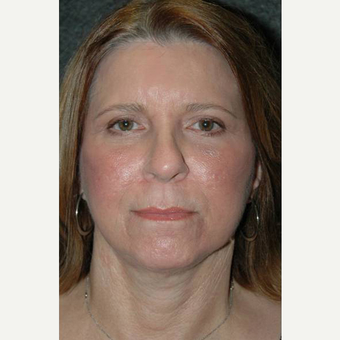 63 year old woman treated with Facelift after 3710750