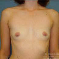 25-34 year old woman treated with Breast Augmentation before 1708088