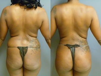 Buttocks enhancement before 929664