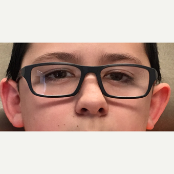 Corrective surgery for protruding, uneven ears - middle-school aged male. before 3847075