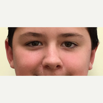 Corrective surgery for protruding, uneven ears - middle-school aged male. after 3847075