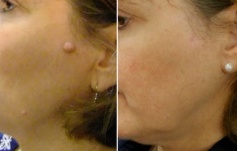 Mole Removal before 1211995