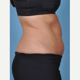 35-44 year old woman treated with CoolSculpting before 2154994