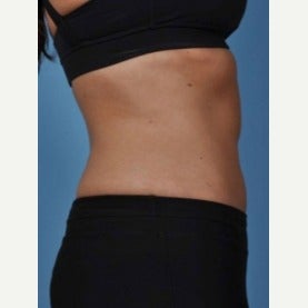 35-44 year old woman treated with CoolSculpting after 2154994