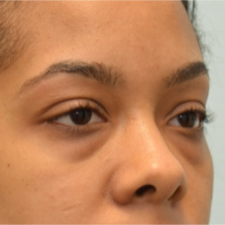 Transconjunctival Blepharoplasty to treat eye bags of 24 year old woman before 2596249