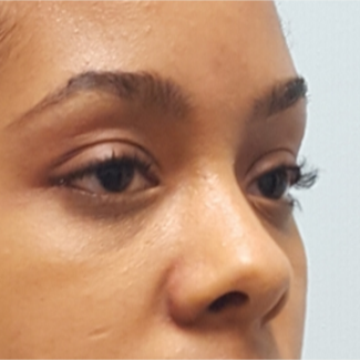 Transconjunctival Blepharoplasty to treat eye bags of 24 year old woman after 2596249