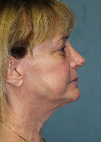 59 Year Old Female "Refined Nose" after 1105115