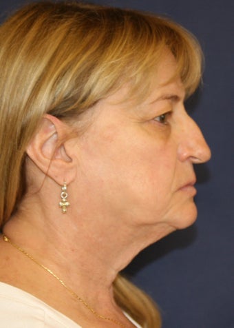 59 Year Old Female "Refined Nose" before 1105115