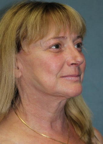 59 Year Old Female "Refined Nose" 1105115