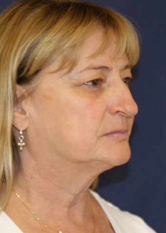 59 Year Old Female "Refined Nose" 1105115