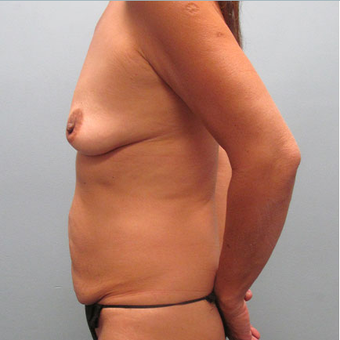 50 year old woman treated with Mommy Makeover before 3680050