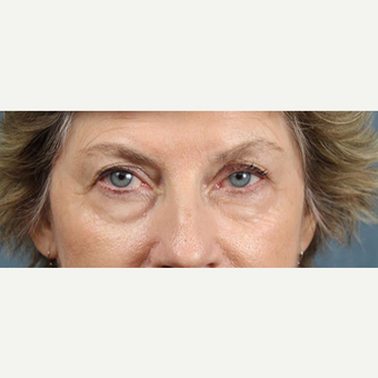 Eyelid Surgery before 3123720