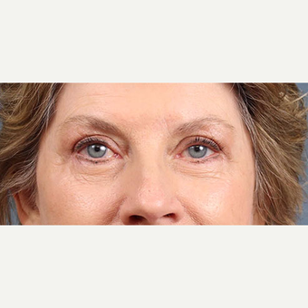 Eyelid Surgery after 3123720