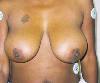 Ultimate Breast Lift - No Implants 7 year follow up before 488076