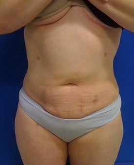 Laser Liposuction 561222
