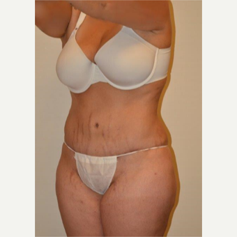 25-34 year old woman treated with Tummy Tuck after 3658520