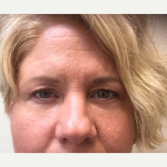 35-44 year old woman treated with Belotero after 3443757
