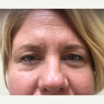 35-44 year old woman treated with Belotero before 3443757