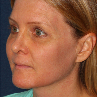 42 year old woman treated with Fraxel Dual laser for Melasma one treatment only after 3616967