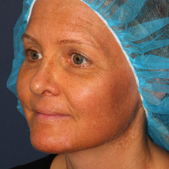 42 year old woman treated with Fraxel Dual laser for Melasma one treatment only before 3616967