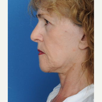 65-74 year old woman treated with a deep plane Facelift before 3466443