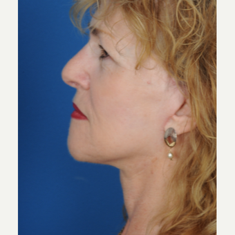 65-74 year old woman treated with a deep plane Facelift after 3466443