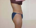 Tummy Tuck 1029909