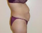 Tummy Tuck 1029909