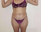 Tummy Tuck before 1029909