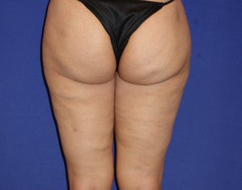 42 Year Old Female Treated with Cellulaze for Cellulite after 1192048