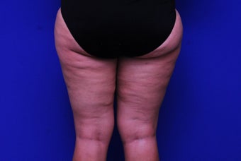 42 Year Old Female Treated with Cellulaze for Cellulite before 1192048