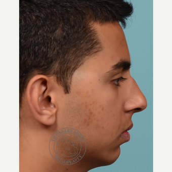 18-24 year old man treated with open Septoplasty/rhinoplasty before 3092828