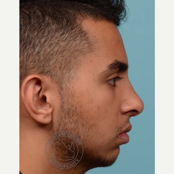 18-24 year old man treated with open Septoplasty/rhinoplasty after 3092828