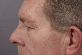 Bilateral eyelid surgery before 321433