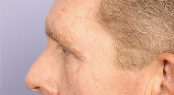 Bilateral eyelid surgery after 321433