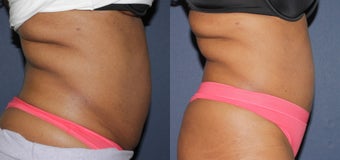 Before & After Liposonix before 806264