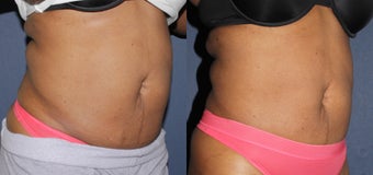 Before & After Liposonix 806264