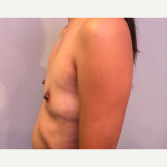 35-44 year old woman treated with Breast Augmentation before 3725964