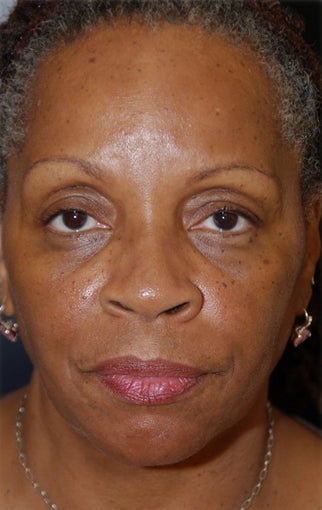 African American female treated with cheek augmentation filler and ZO Skin Health before 1412781